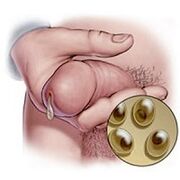 klamidiaren isurketa
